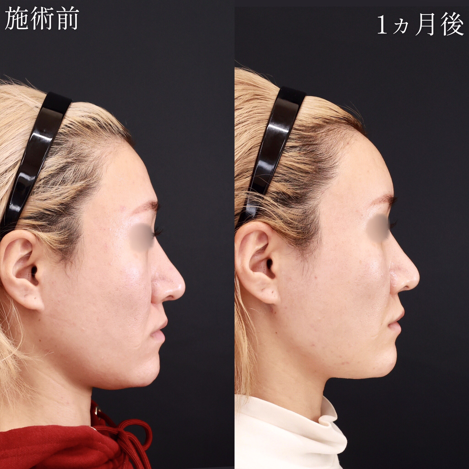 顔の脂肪注入(コンデンスリッチフェイス)/下眼瞼脱脂術(目の下のたるみ取り・目の下の脂肪ふくらみ取り)/TAC式 ツヤ肌コラーゲンリフト®の症例写真 施術前後