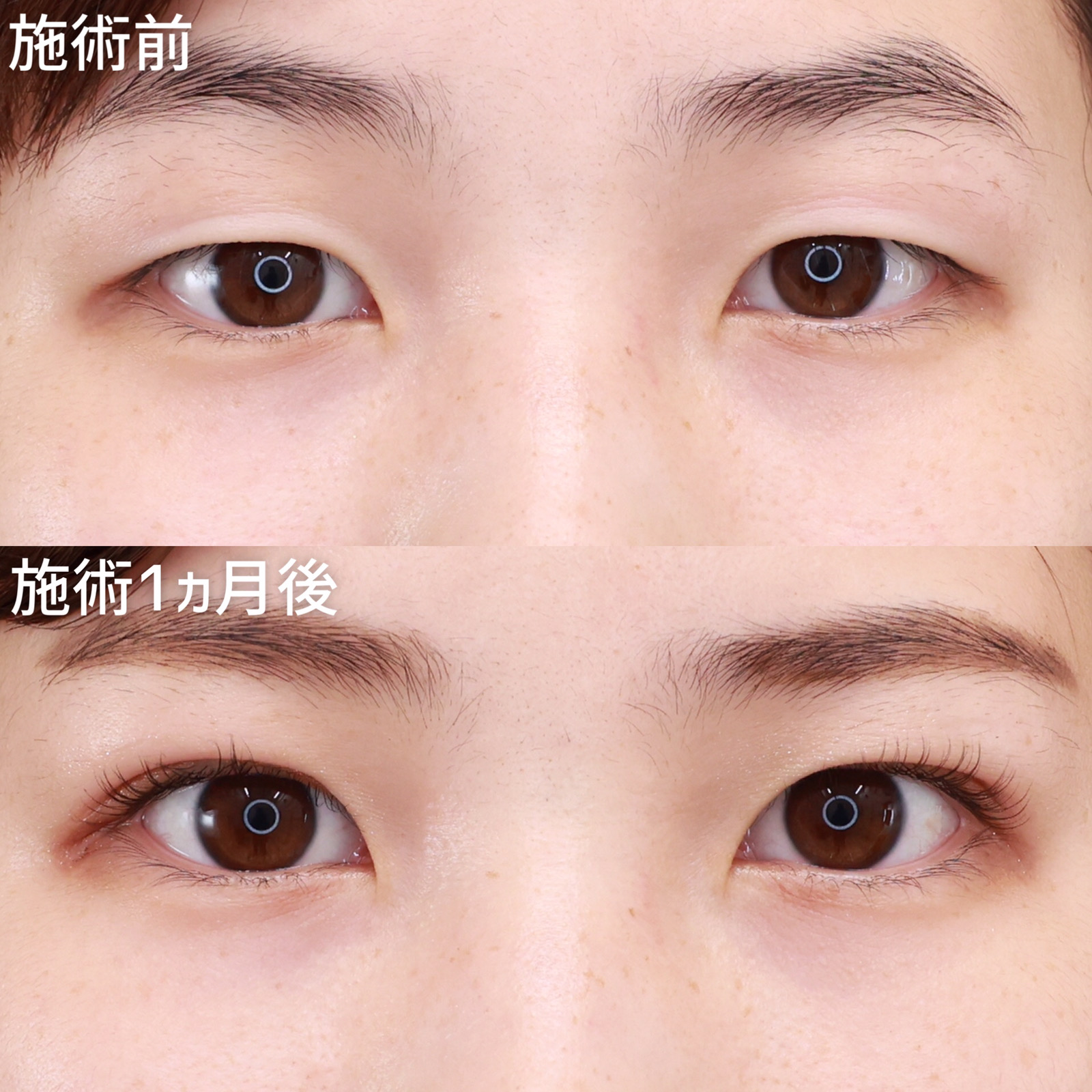 【二重埋没法】ナチュラルに映える末広二重で目力アップ！