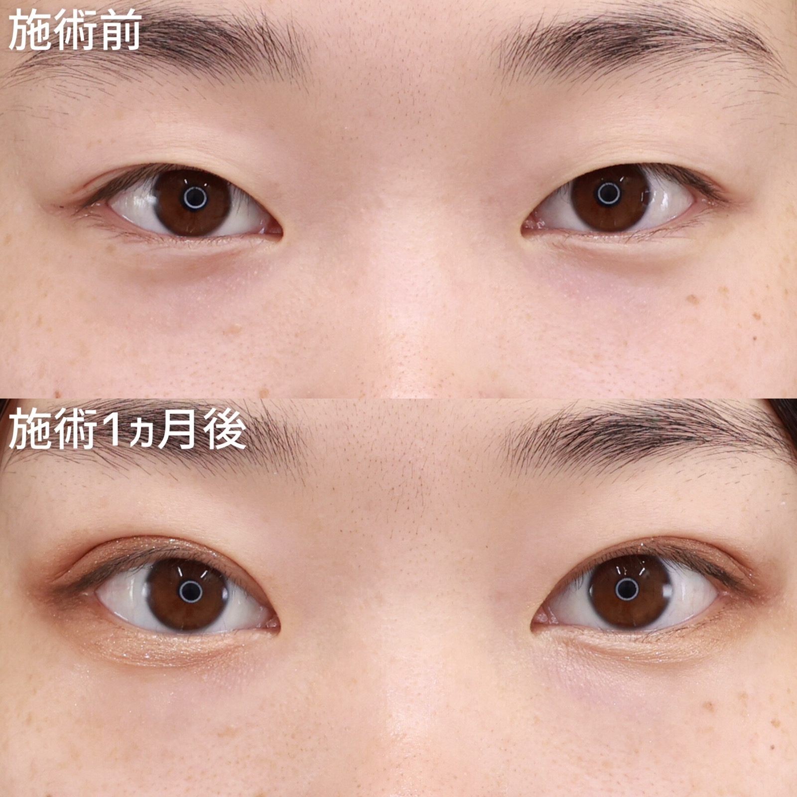 クイックコスメリングの症例写真 施術前後