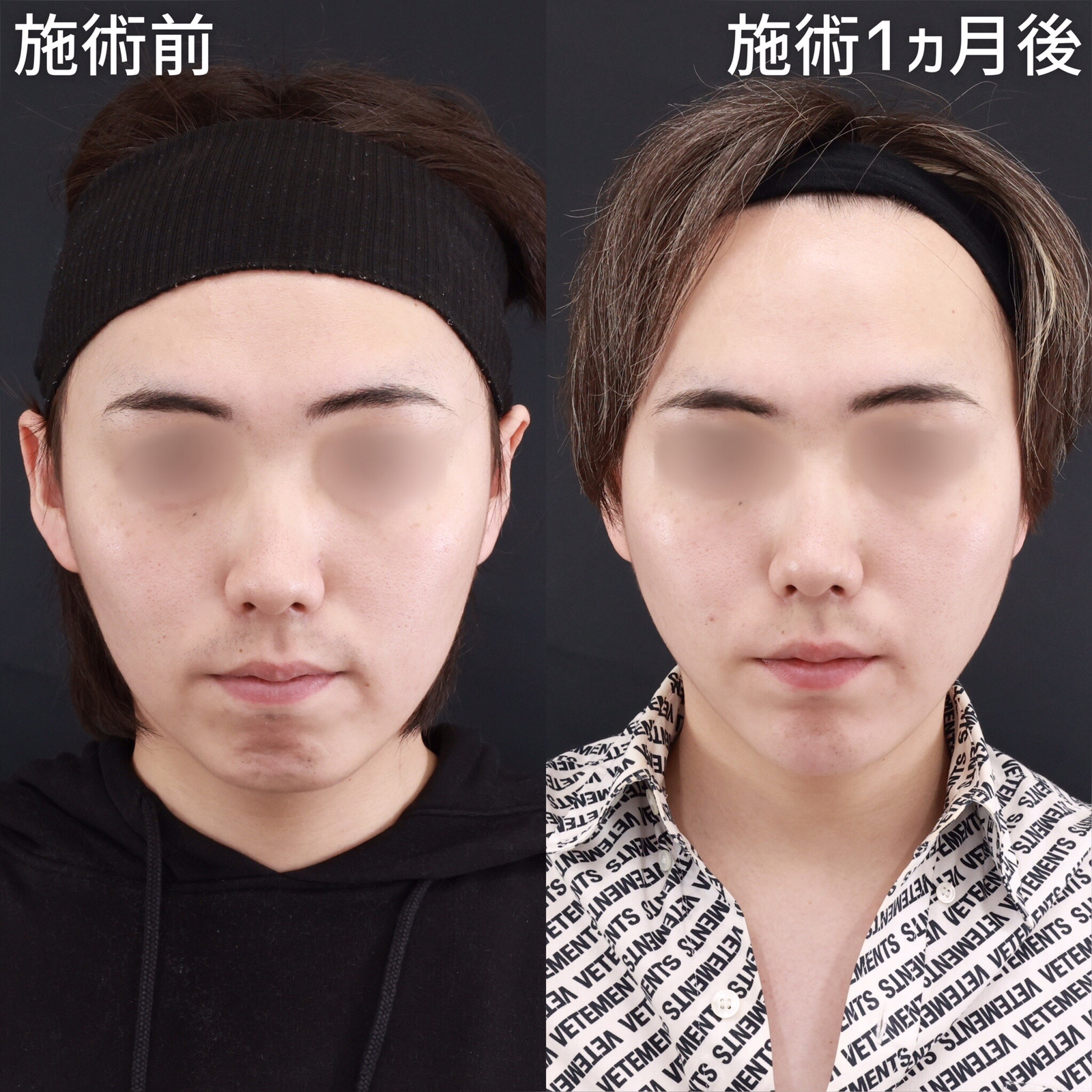 ジョールファット除去/TAC式 ツヤ肌コラーゲンリフト®/顎のヒアルロン酸注射の症例写真 施術前後 