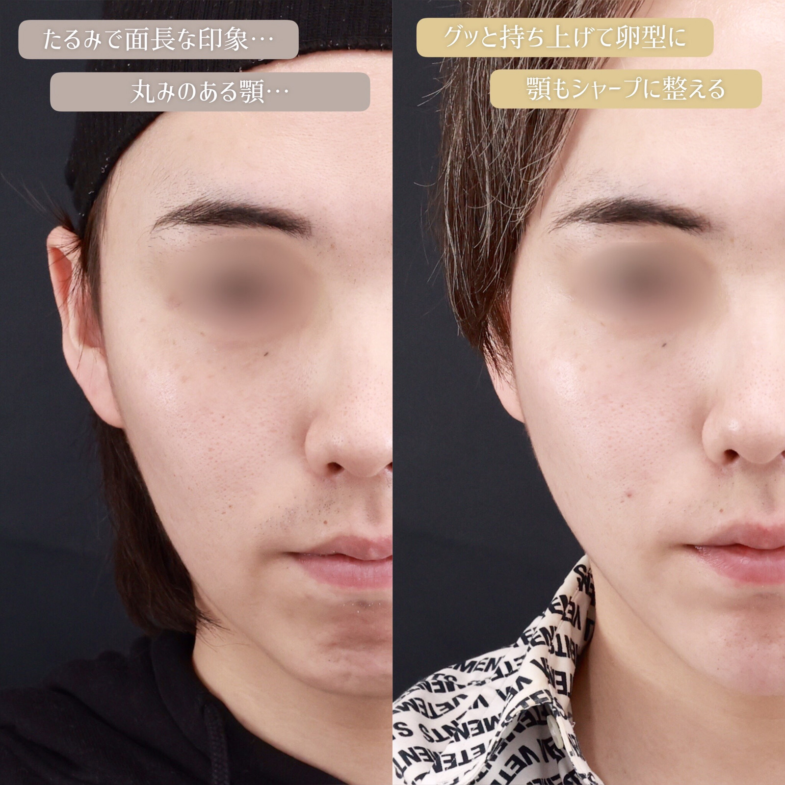 ジョールファット除去/TAC式 ツヤ肌コラーゲンリフト®/顎のヒアルロン酸注射の症例写真 施術前後 