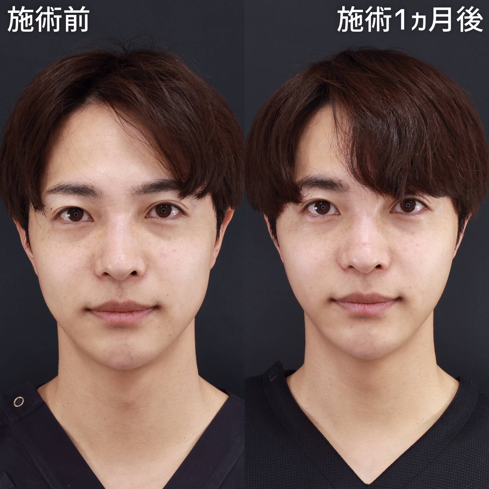 【パーフェクトフェイスライン】TAクリニックの森ドクターの小顔整形を担当しました