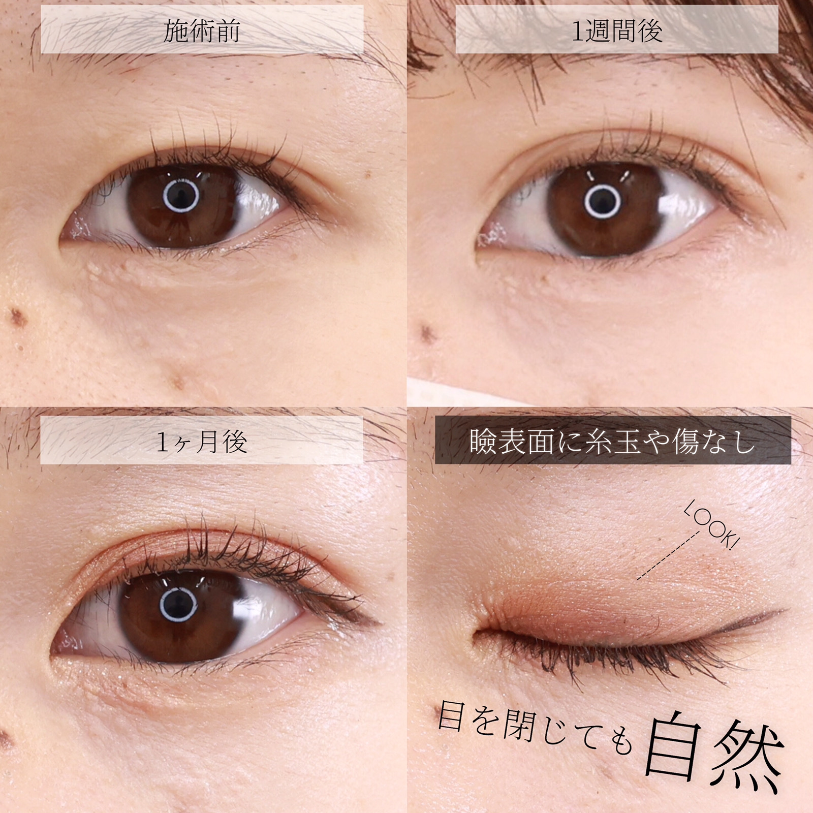 クイックコスメリングの症例写真 施術前後 