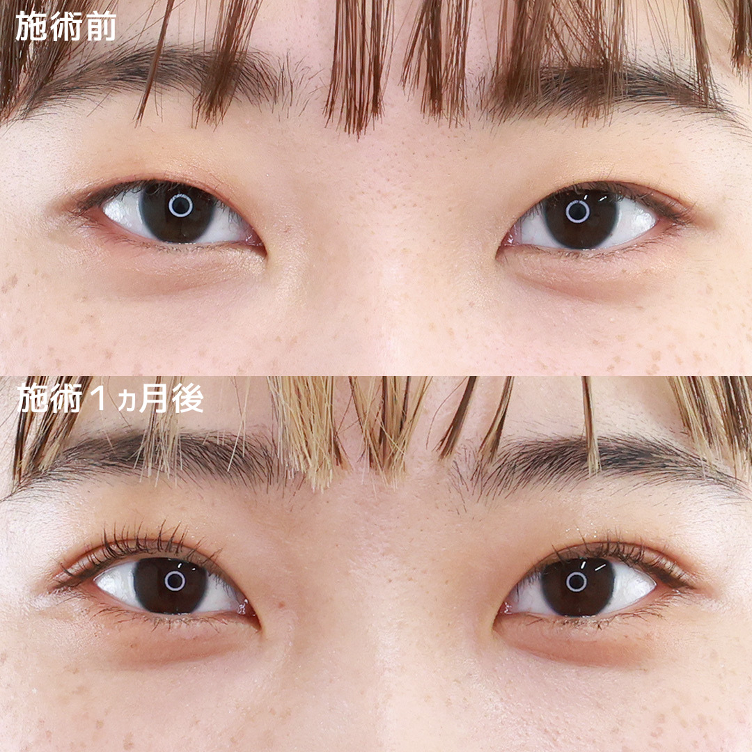 【二重埋没法】自然な末広二重へ