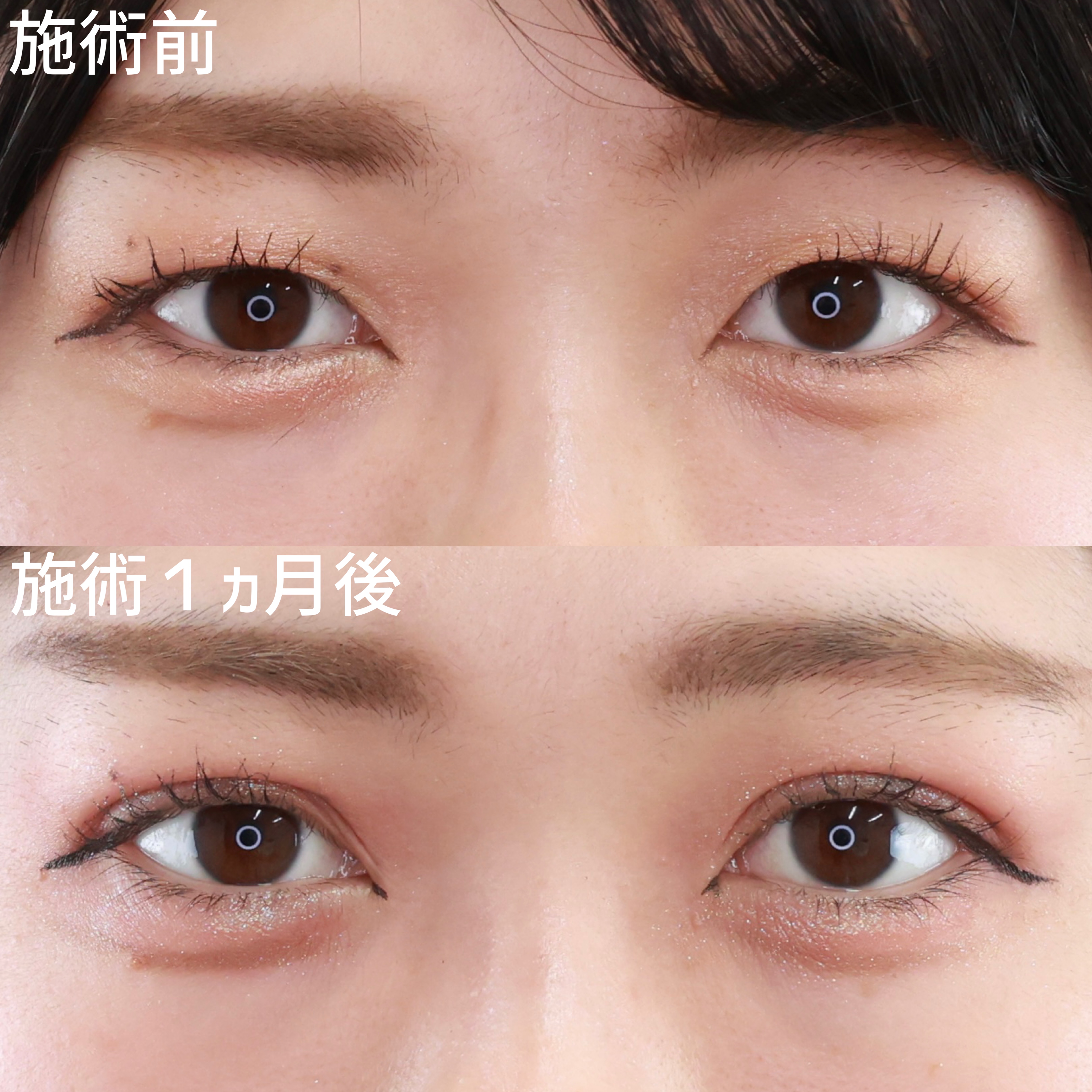 【二重埋没法】二重テープを卒業！目力UPで新しい自分