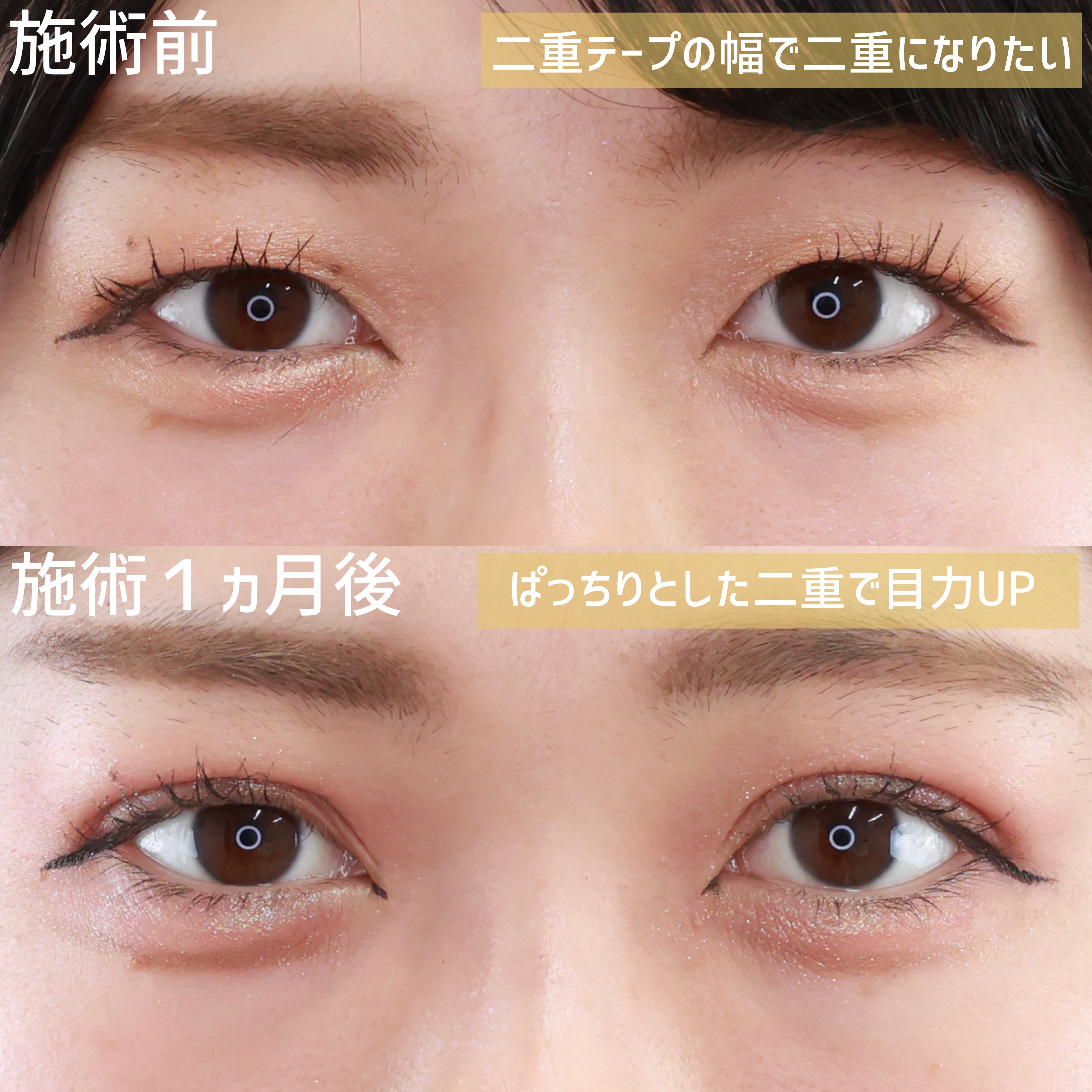 二重埋没法/目元：その他の症例写真 施術前後 