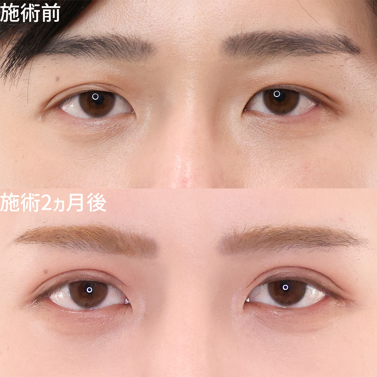 【メンズ二重】切開法で半永久的にパッチリ華やか【上まぶたのたるみ取り】