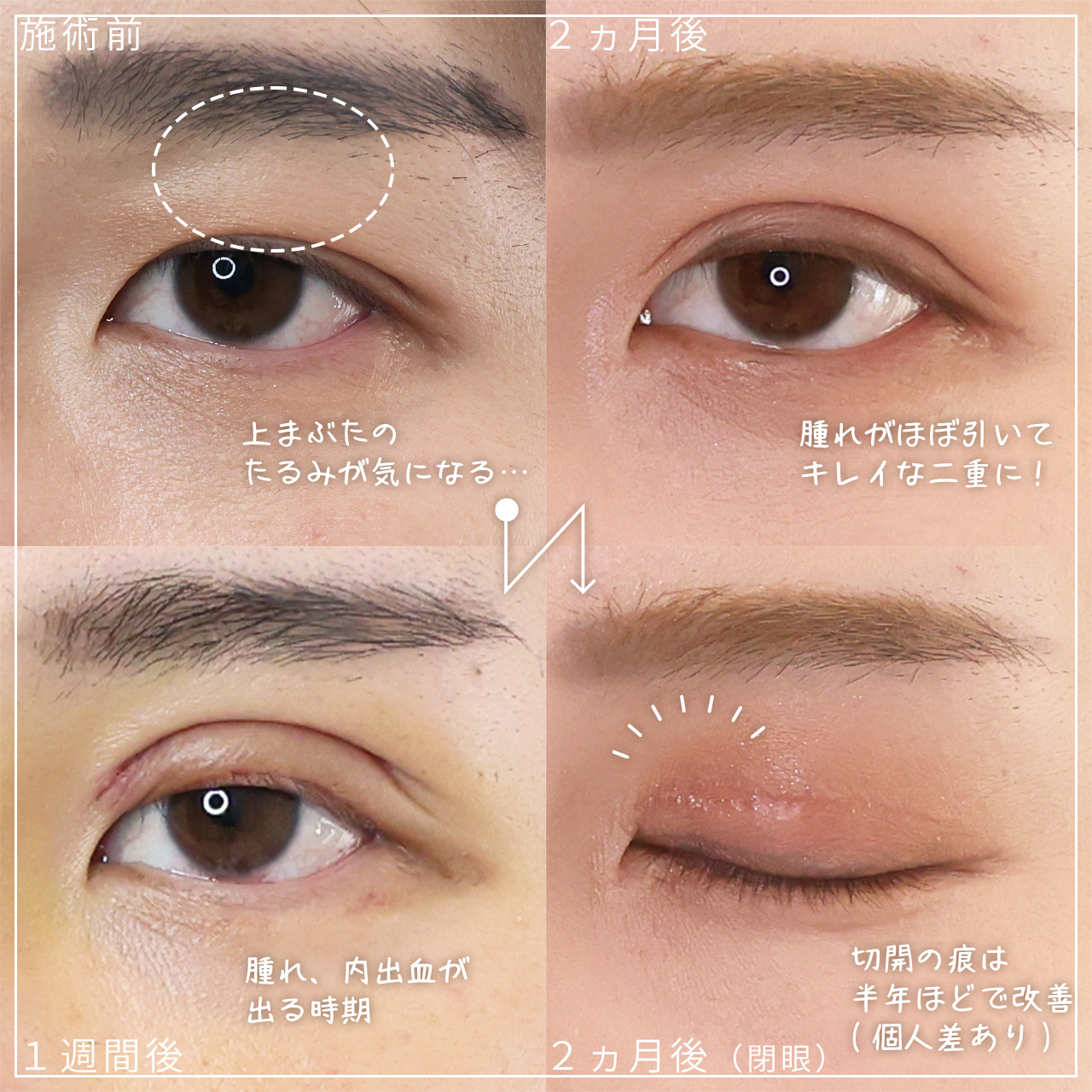 上眼瞼切開術の症例写真 施術前後 