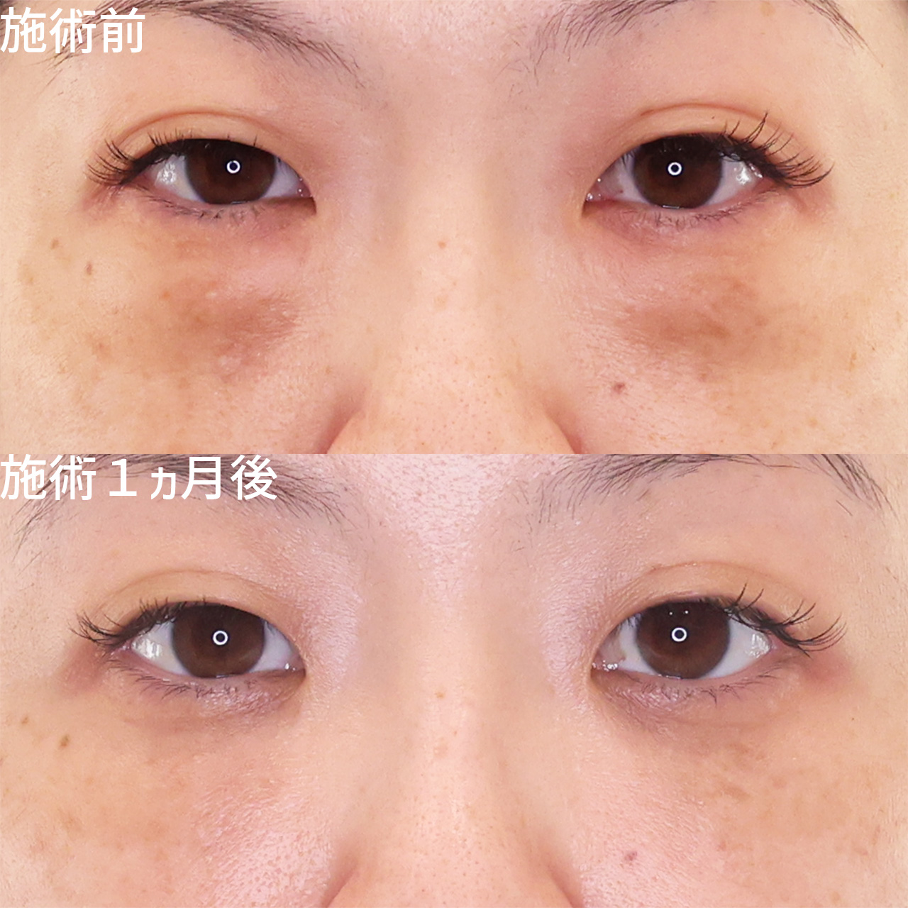 老け見えを解消する目の下のふくらみ取り＋脂肪注入
