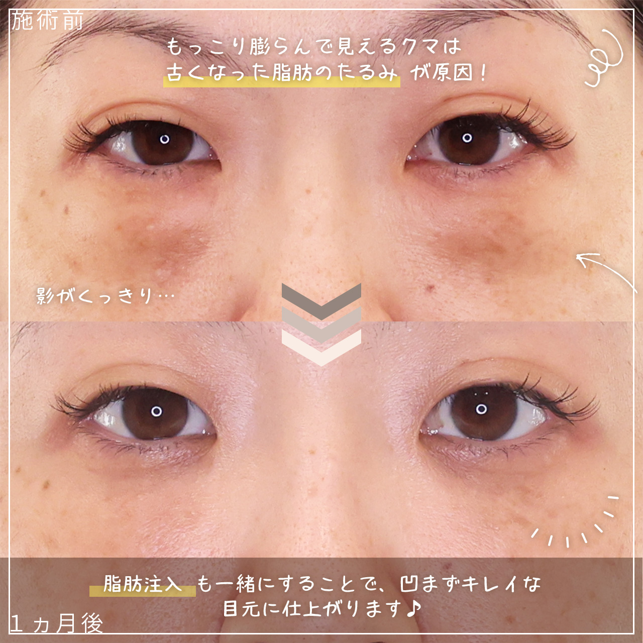 下眼瞼脱脂術（目の下のたるみ取り・目の下の脂肪ふくらみ取り）/顔の脂肪注入(コンデンスリッチフェイス)の症例写真 施術前後 