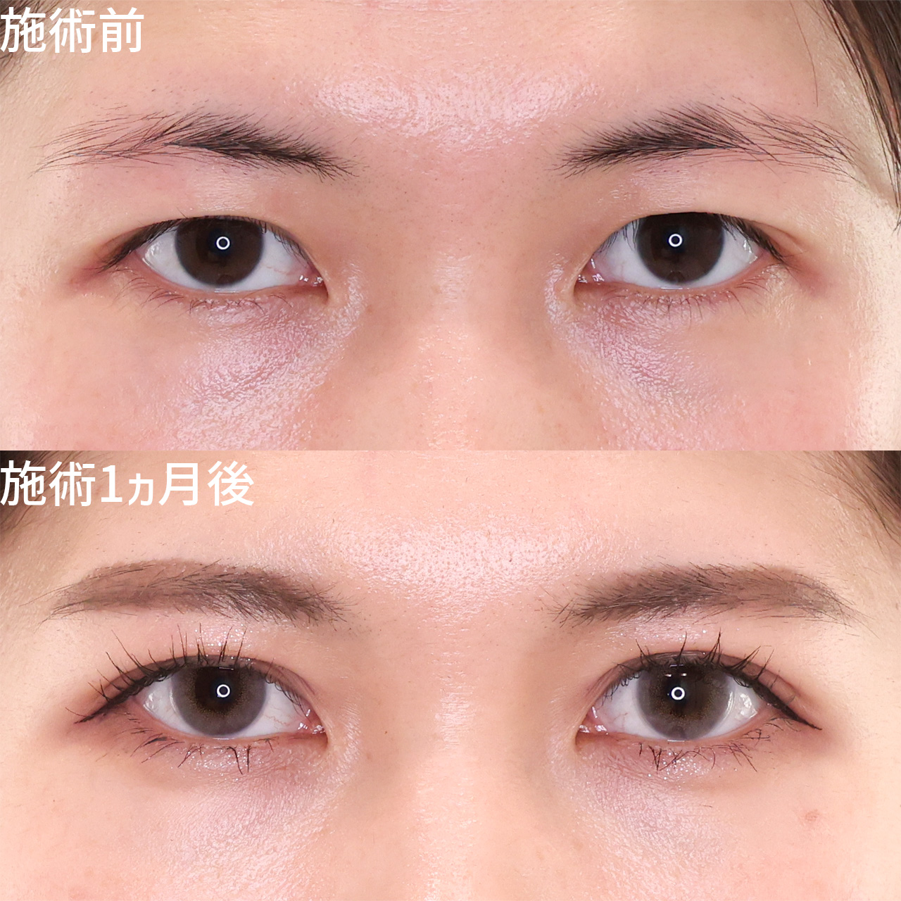 メイク隠れ、お悩みではないですか？奥二重卒業でメイク映えするお目元に