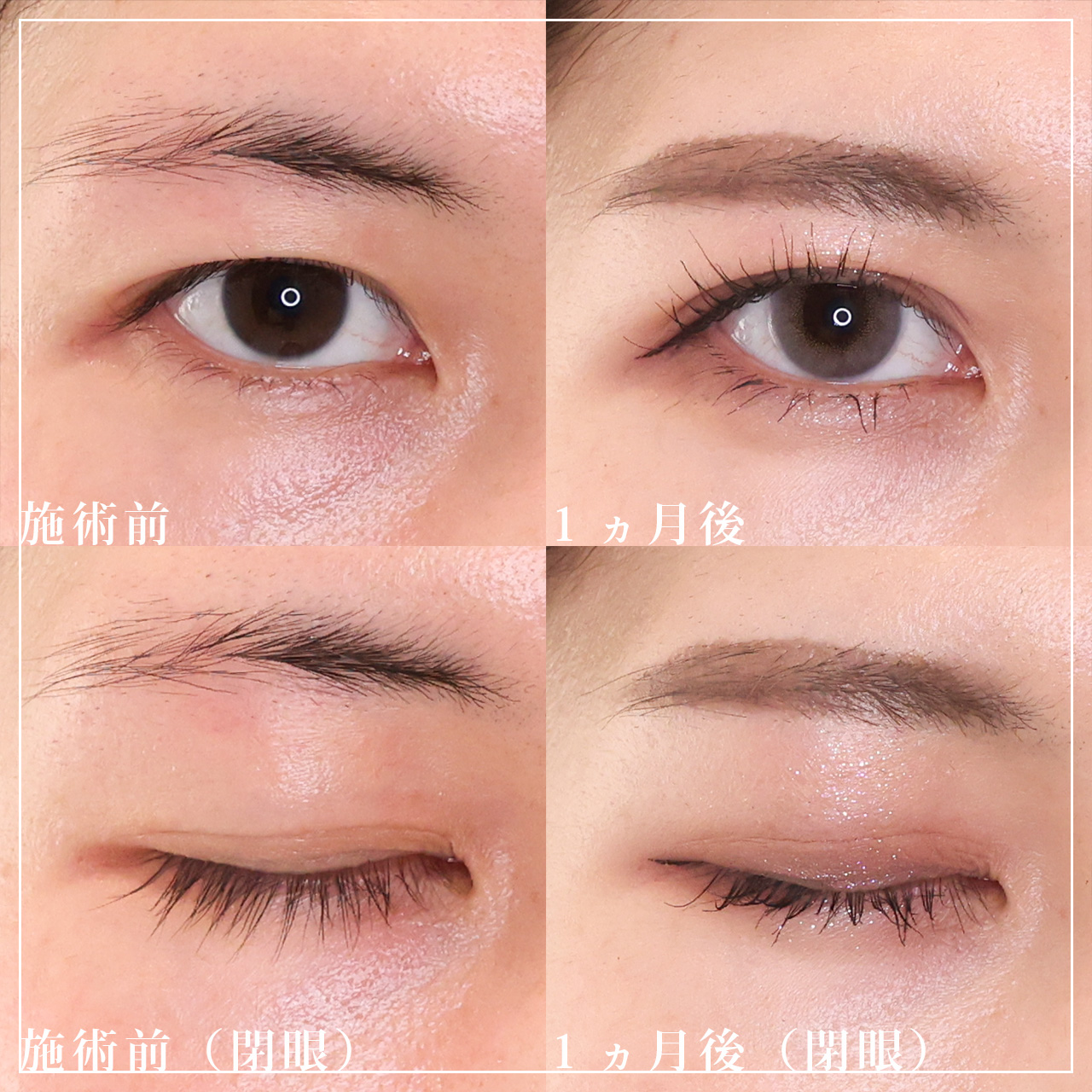 二重埋没法の症例写真 施術前後 