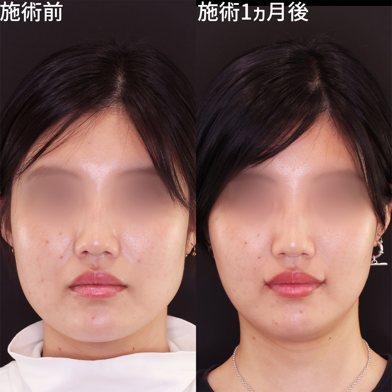 口角挙上・リフト(マイクロ切開法・内側法/口内法)の症例写真 施術前後