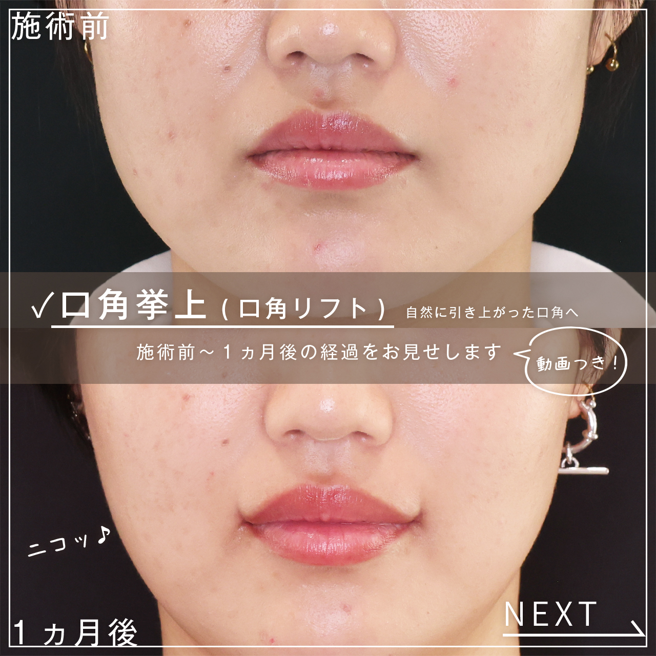 口角挙上・リフト(マイクロ切開法・内側法/口内法)の症例写真 施術前後