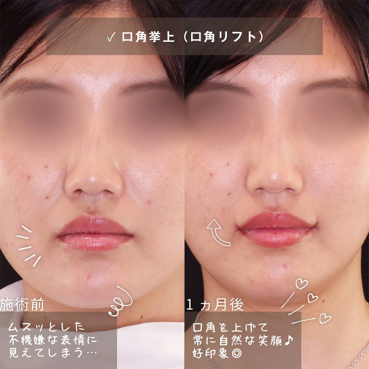 口角挙上・リフト(マイクロ切開法・内側法/口内法)の症例写真 施術前後