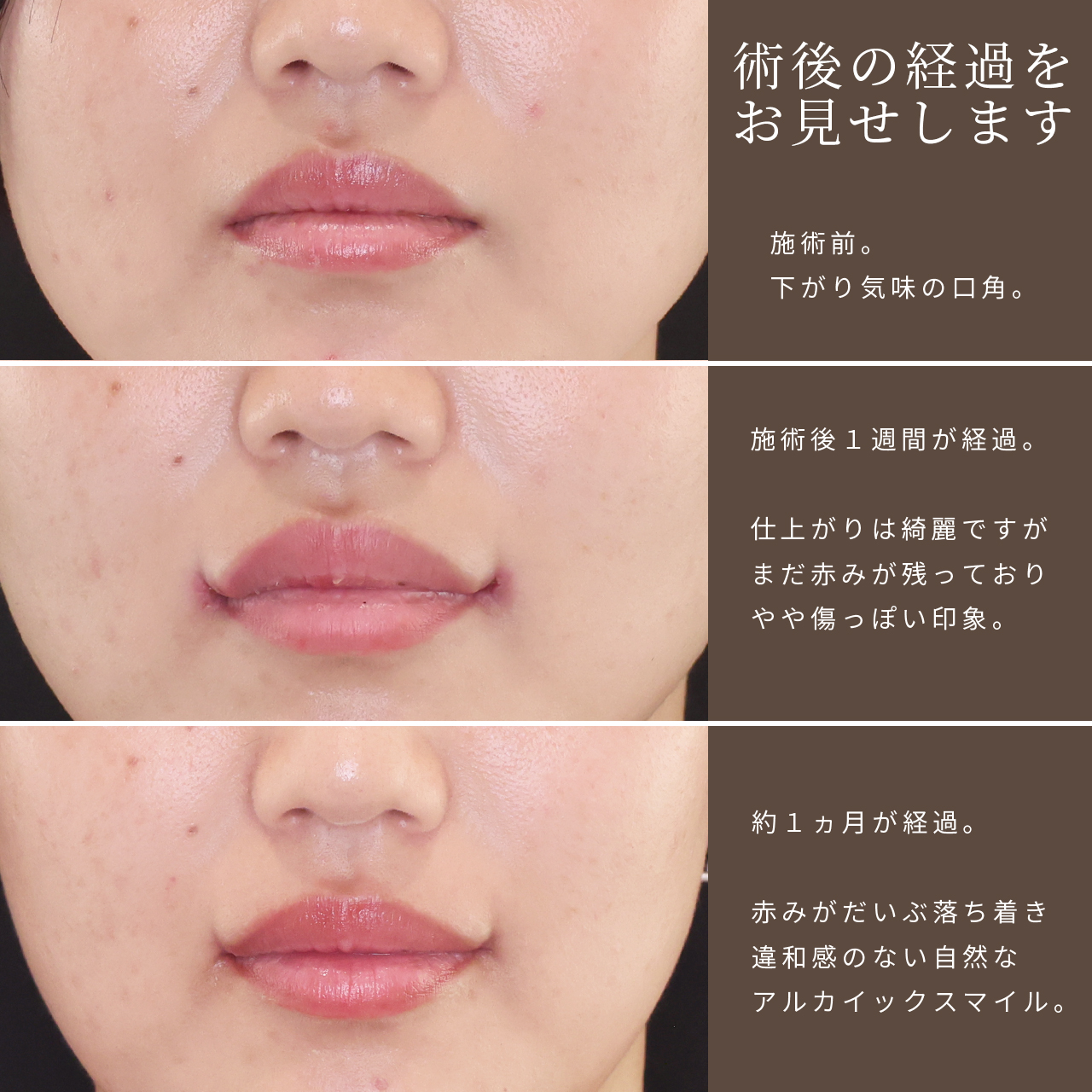 口角挙上・リフト(マイクロ切開法・内側法/口内法)の症例写真 施術前後
