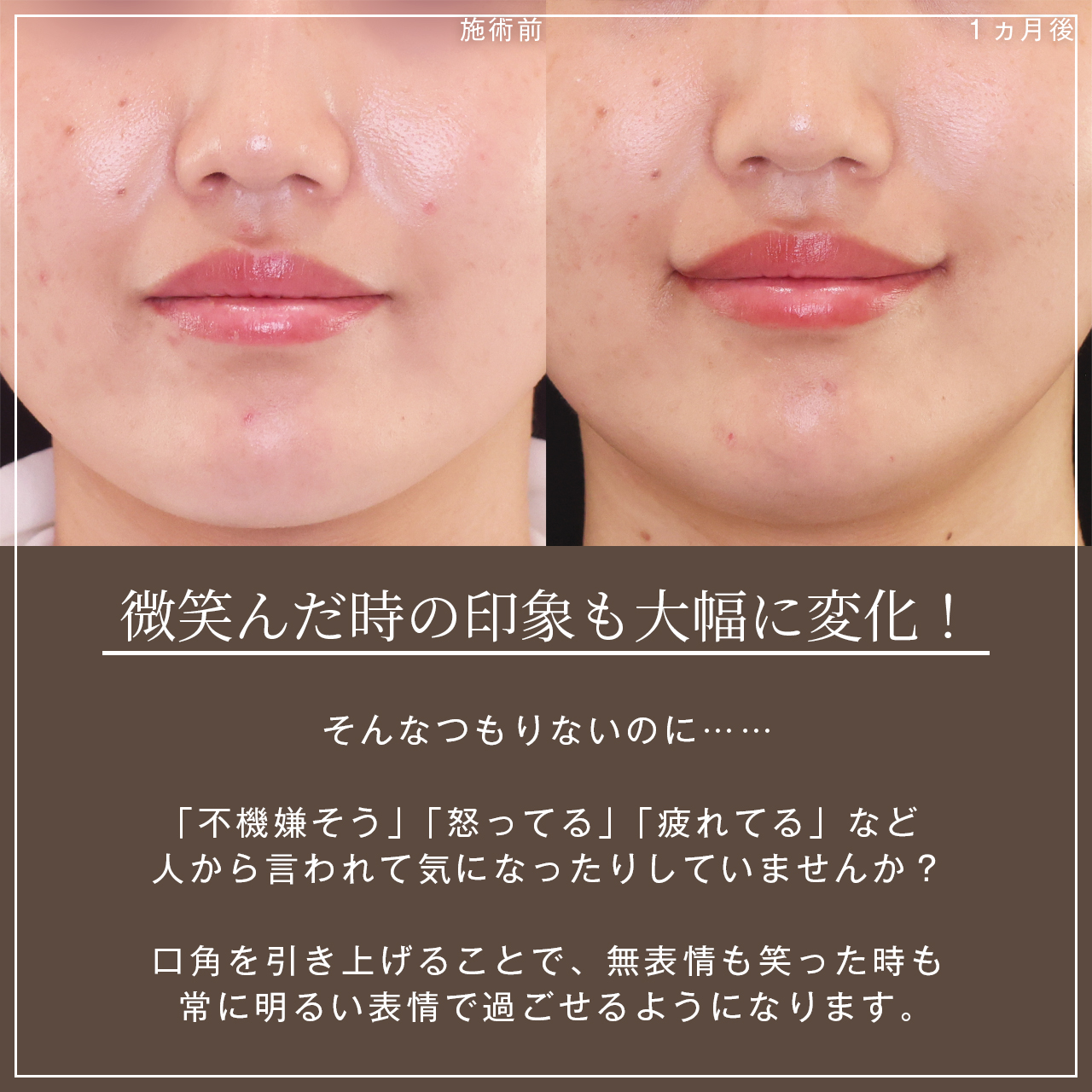 口角挙上・リフト(マイクロ切開法・内側法/口内法)の症例写真 施術前後