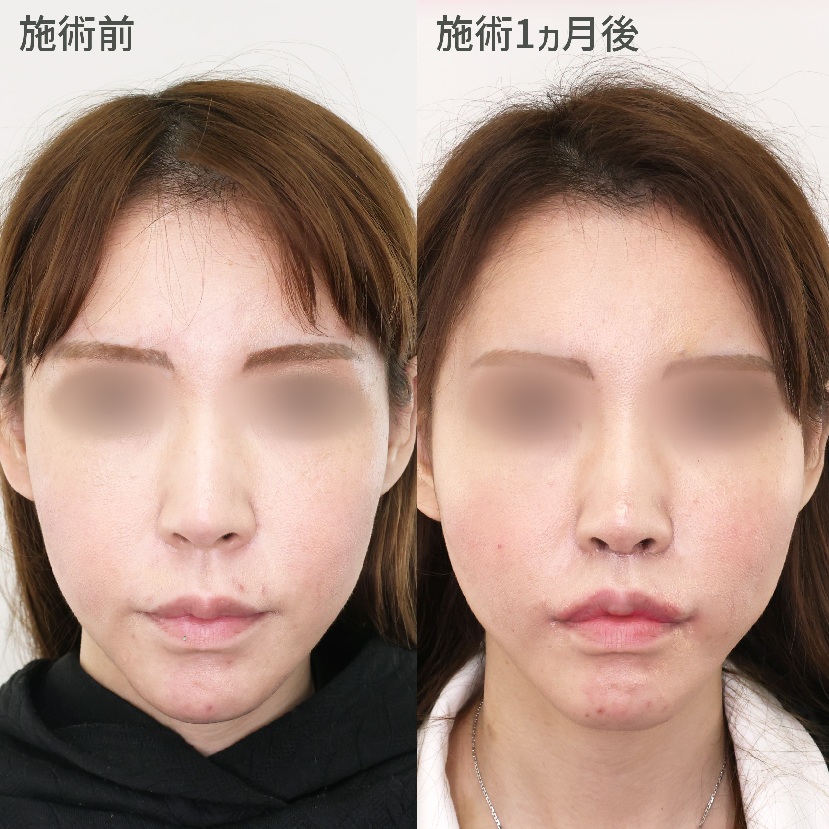 フェイスリフトで卵型の輪郭に【糸リフト×人中短縮】