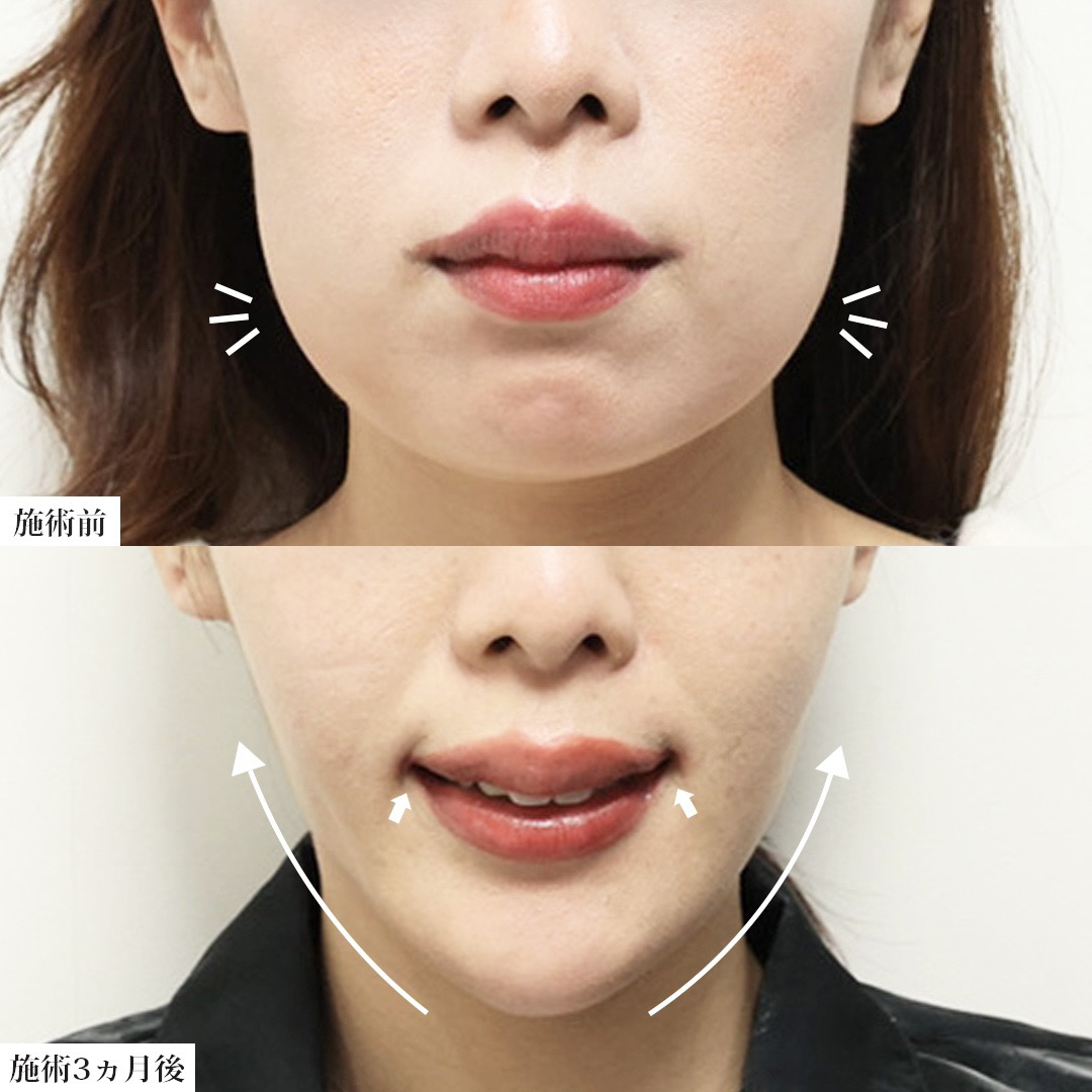 TAC式 ツヤ肌コラーゲンリフト®/ジョールファット除去/バッカルファット除去の症例写真 施術前後