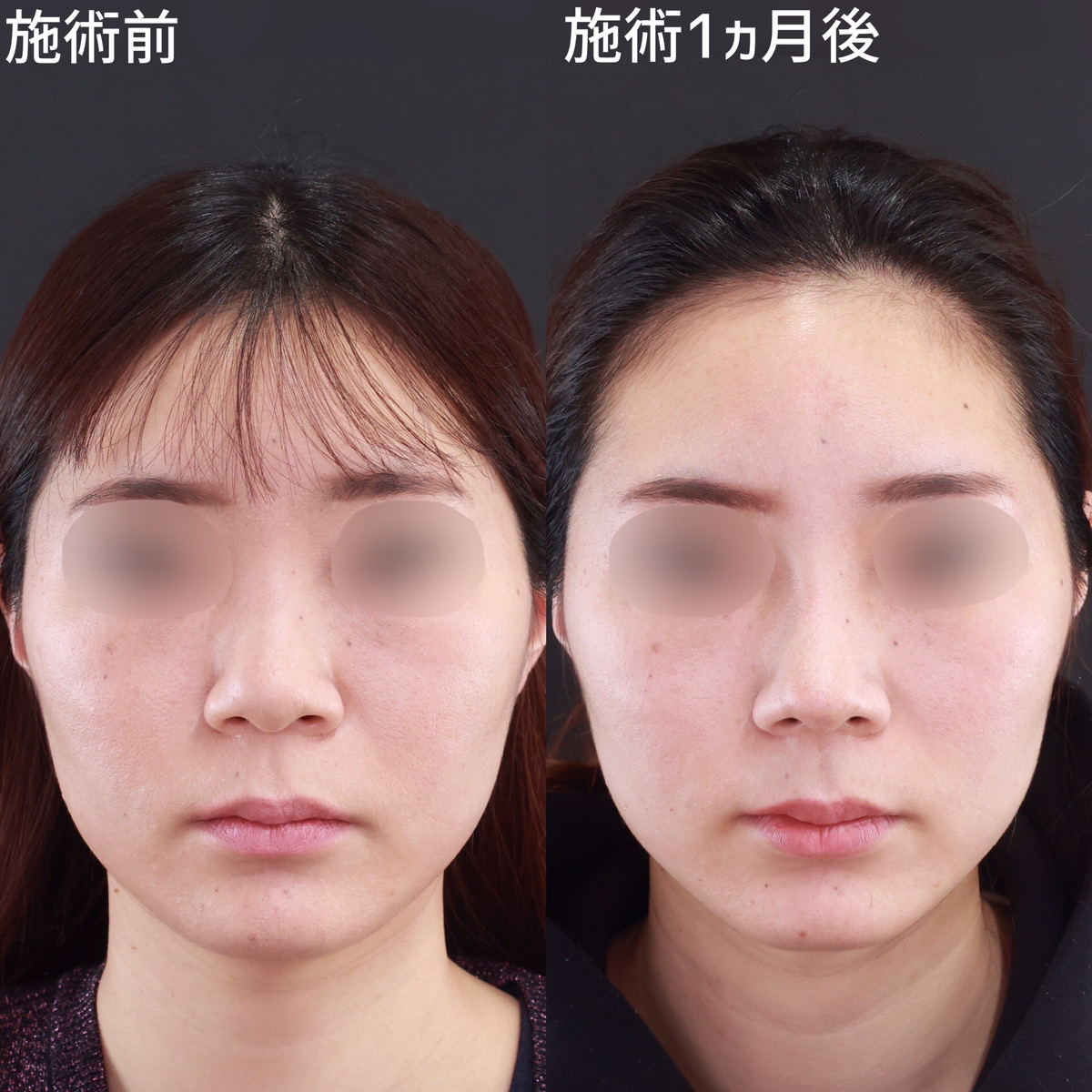 鼻尖形成・鼻尖縮小/隆鼻術（プロテーゼ・自家組織）/鼻中隔延長術の症例写真 施術前後 