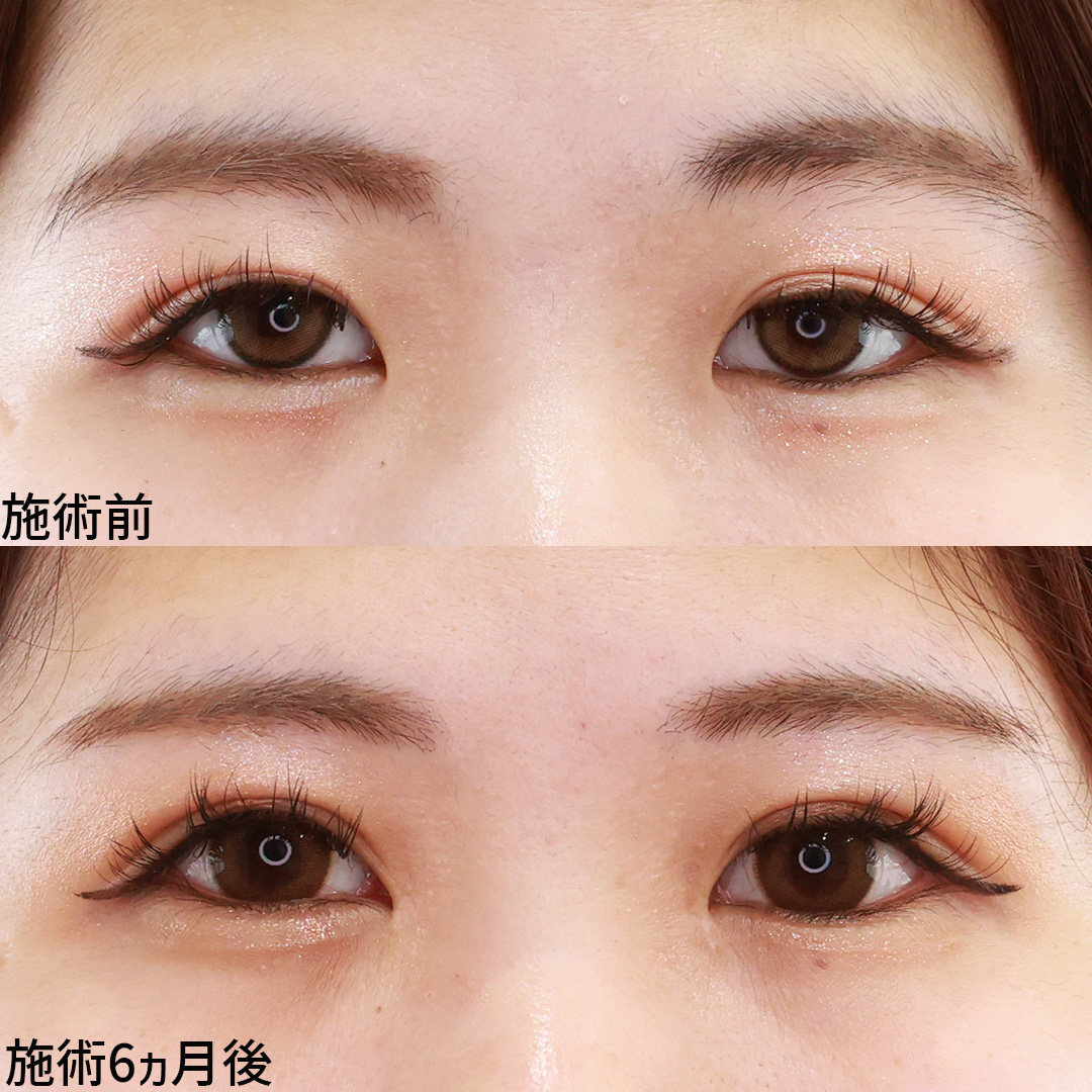 目頭切開術/上眼瞼切開術の症例写真 施術前後