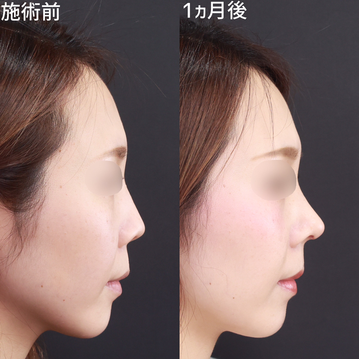 鼻中隔延長術/鼻尖形成・鼻尖縮小/鼻先軟骨移植の症例写真 施術前後 