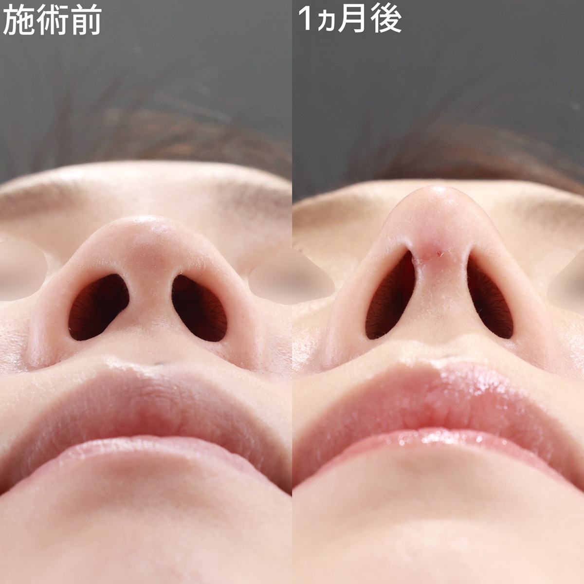 鼻中隔延長術/鼻尖形成・鼻尖縮小/鼻先軟骨移植の症例写真 施術前後 