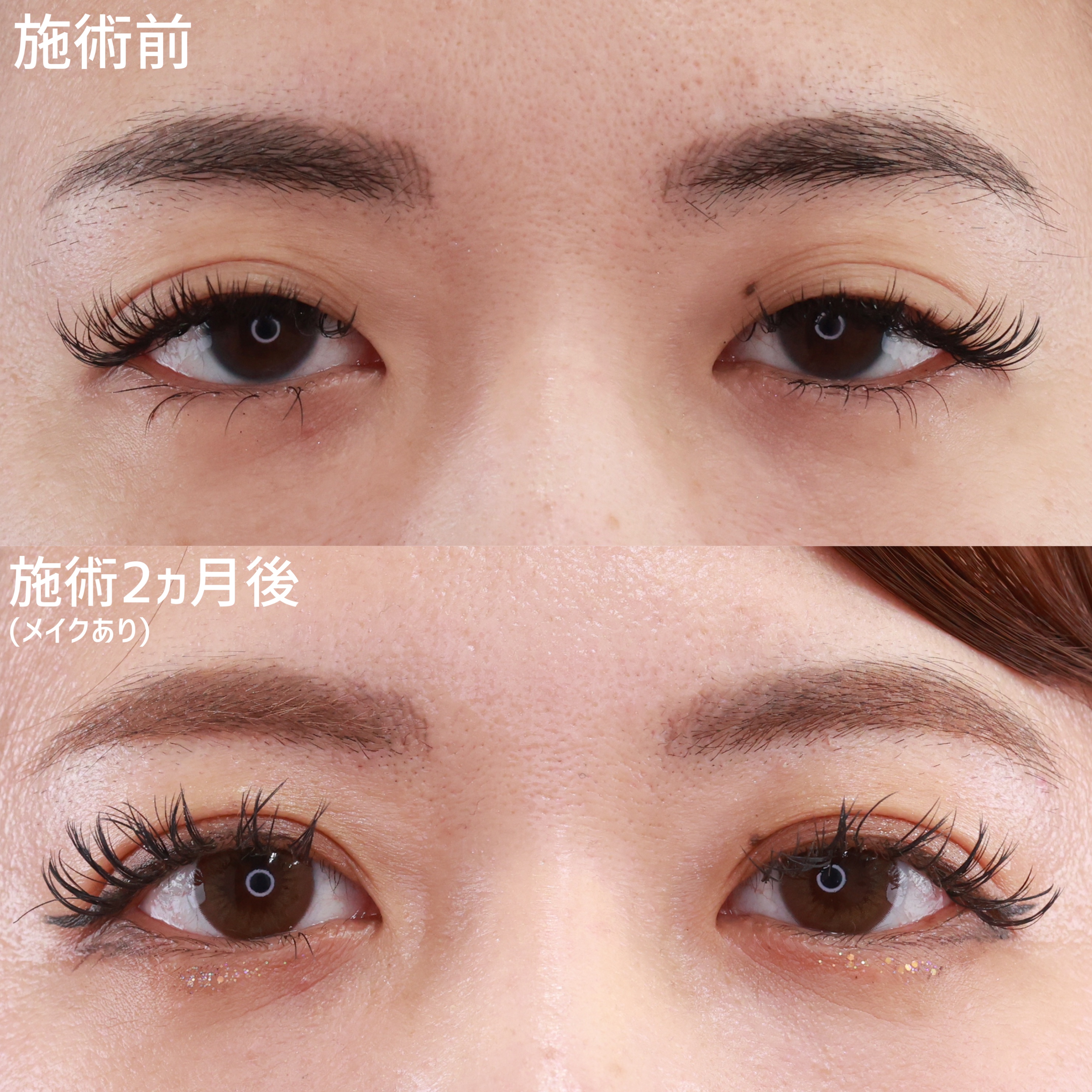 【二重埋没法】くっきり二重で好印象！