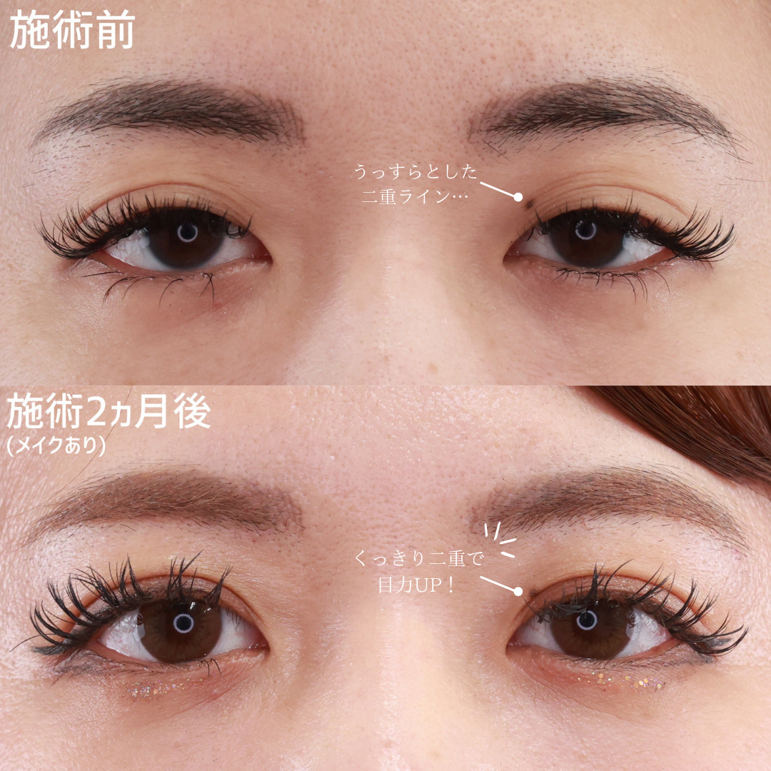 二重埋没法の症例写真 施術前後 