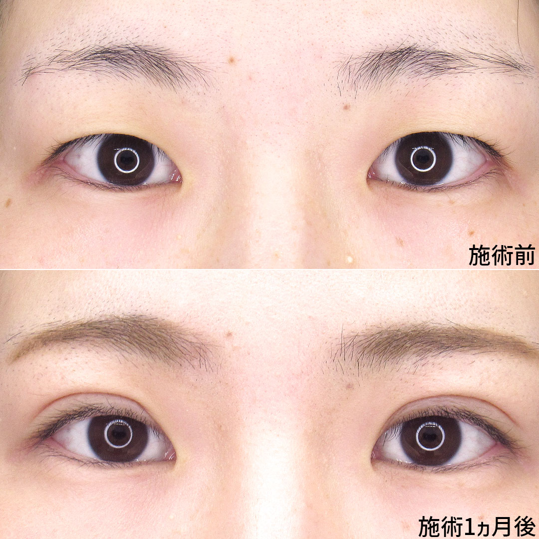 二重埋没法の症例写真 施術前後