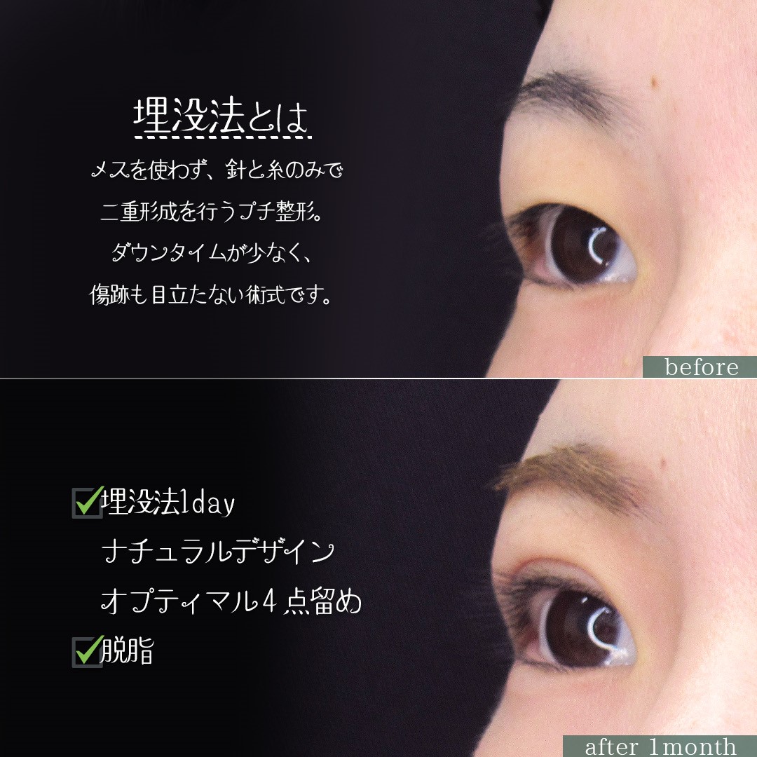 二重埋没法の症例写真 施術前後