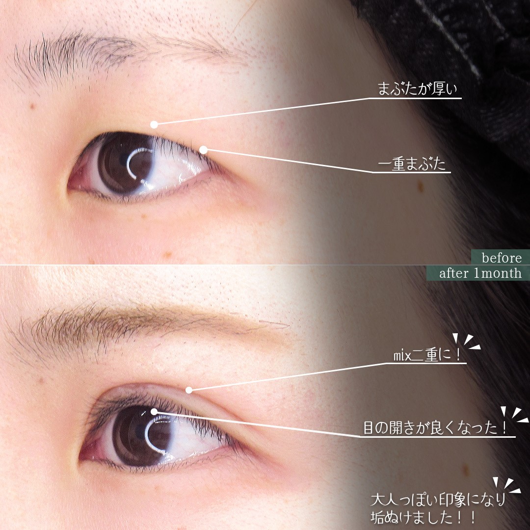 二重埋没法の症例写真 施術前後