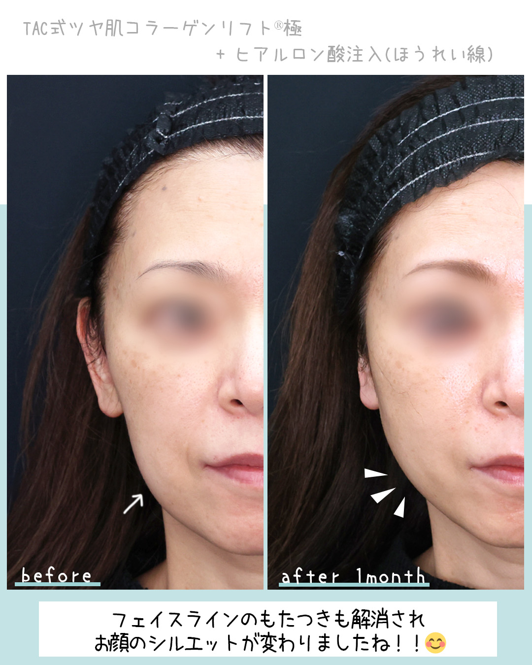 TAC式 ツヤ肌コラーゲンリフト®/ほうれい線のヒアルロン酸注射の症例写真 施術前後 