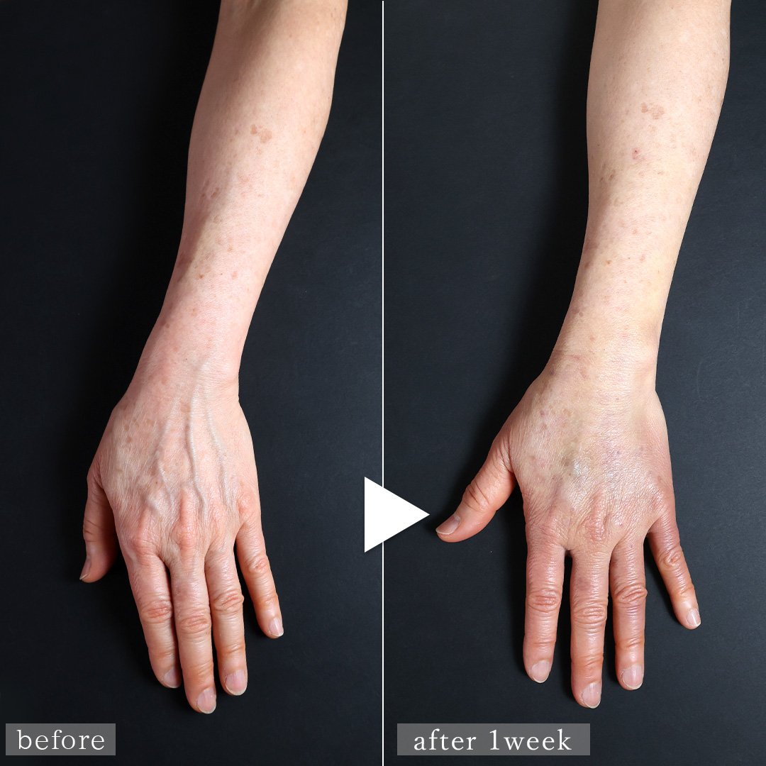 ハンドベイン（手のアンチエイジング・血管治療）の症例写真 施術前後 