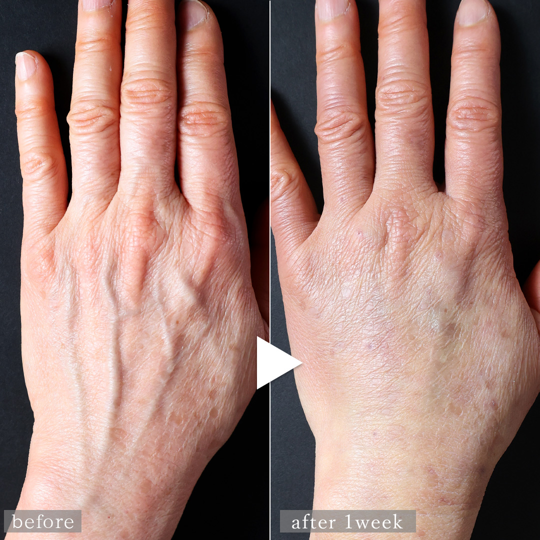 ハンドベイン（手のアンチエイジング・血管治療）の症例写真 施術前後 