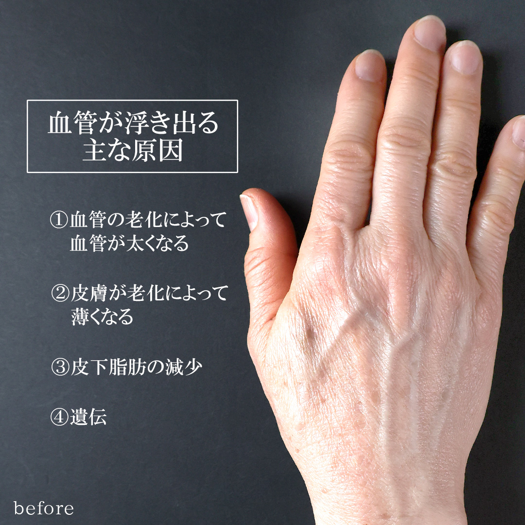 ハンドベイン（手のアンチエイジング・血管治療）の症例写真 施術前後 
