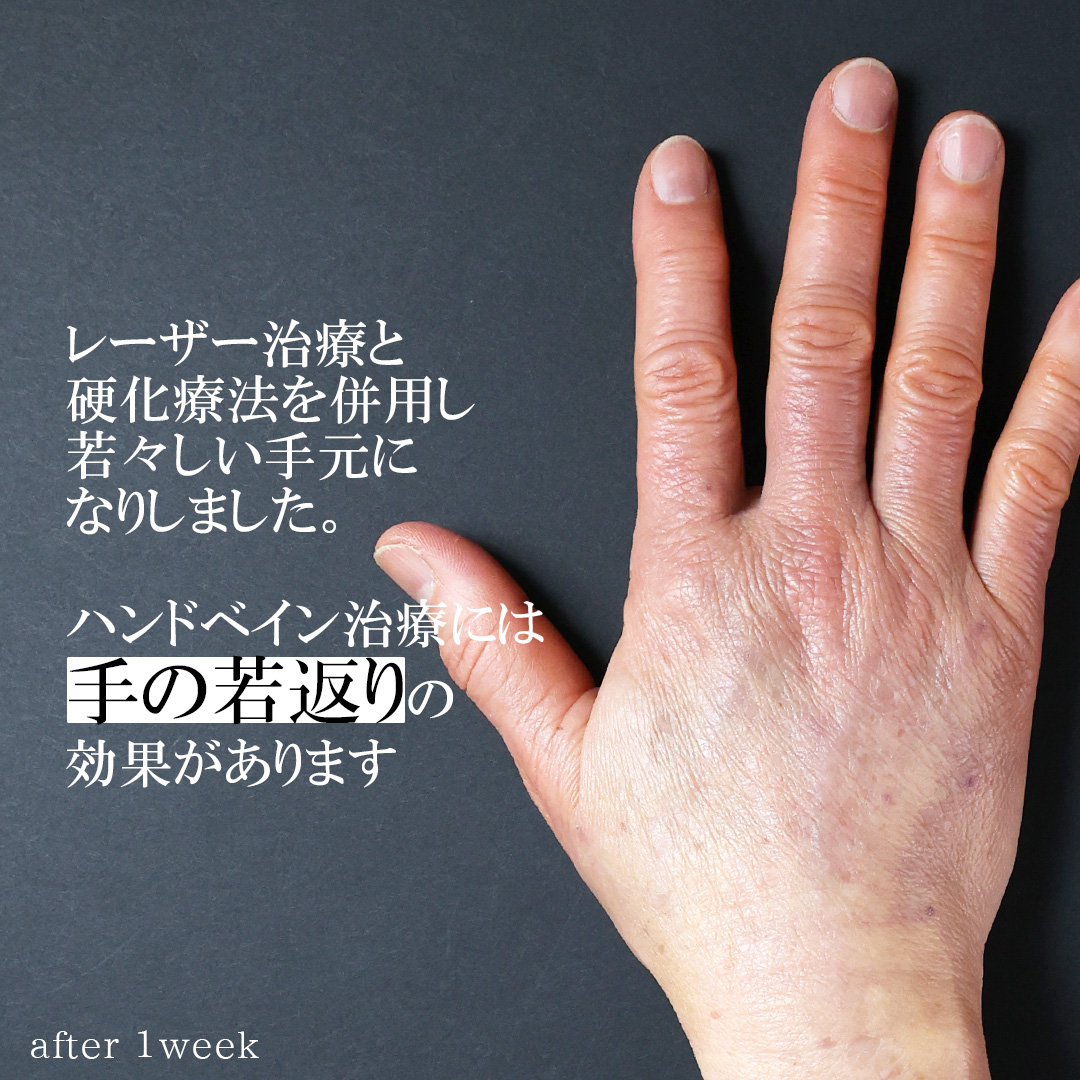 ハンドベイン（手のアンチエイジング・血管治療）の症例写真 施術前後 
