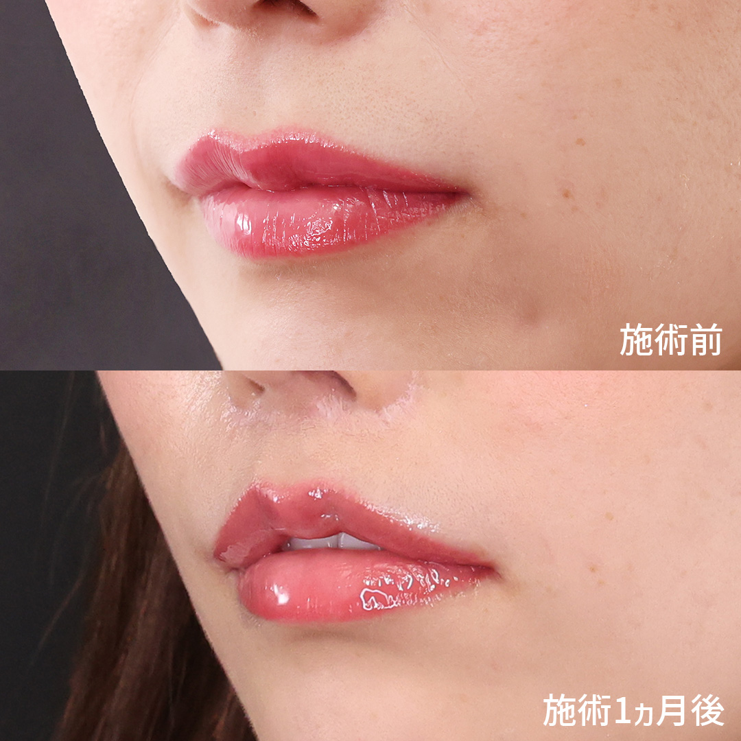 M字リップ形成術の症例写真 施術前後 