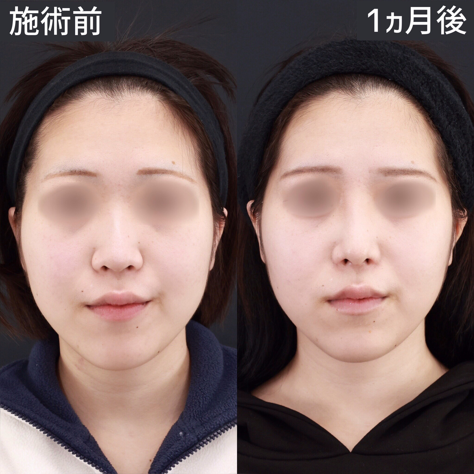 鼻中隔延長で、今流行の韓国風アップノーズに｜症例写真・ビフォーアフター｜美容整形･美容外科のTAクリニックグループ