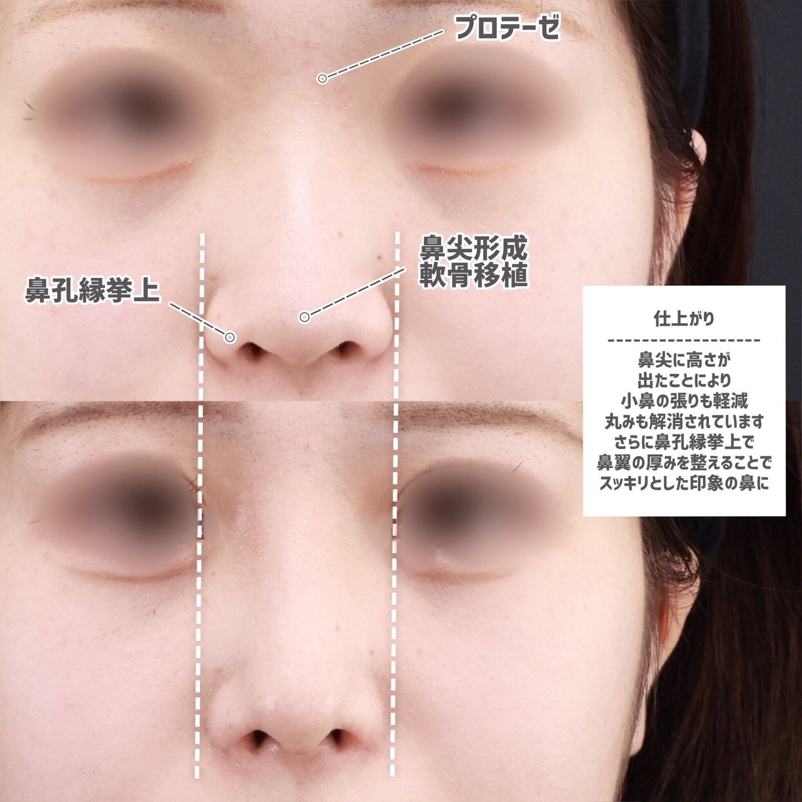 鼻孔縁挙上術/鼻尖形成・鼻尖縮小/隆鼻術（プロテーゼ・自家組織）の症例写真 施術前後 