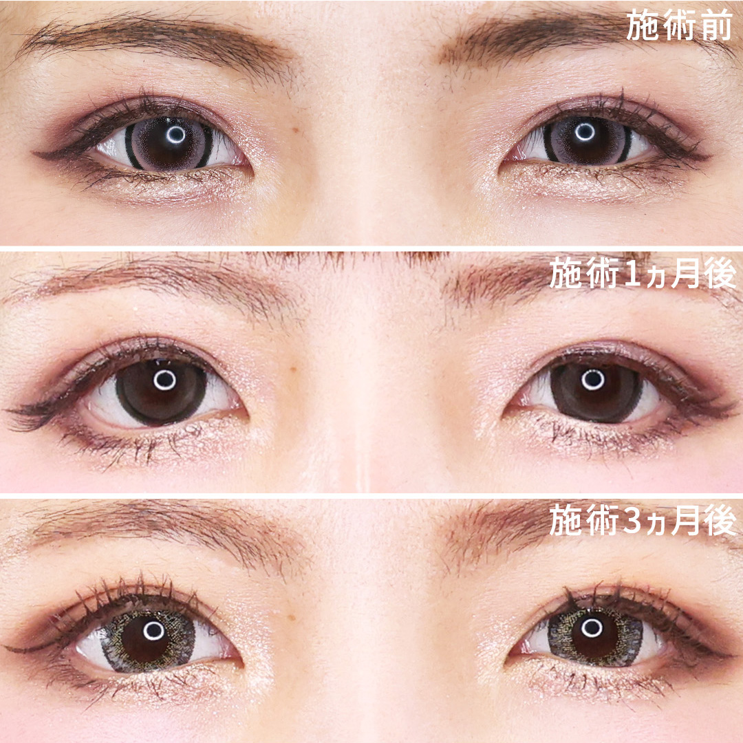 グラマラスライン（タレ目形成）の症例写真 施術前後 