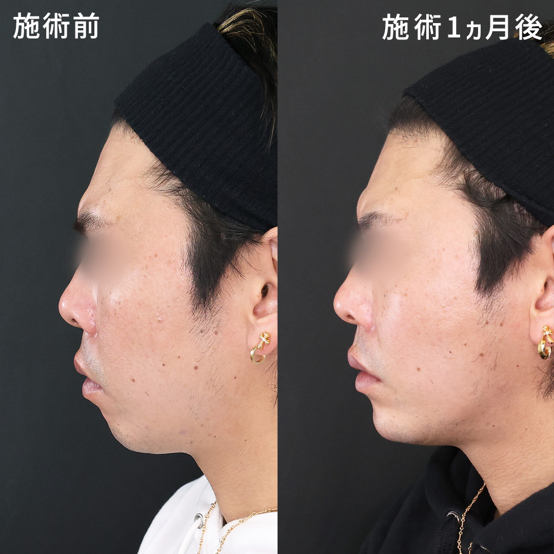 フェイスラインを整え垢抜け◎