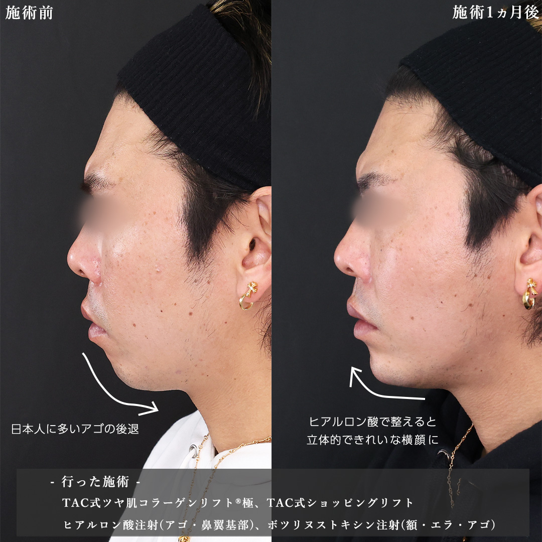 TAC式 ツヤ肌コラーゲンリフト®/TAC式 ショッピングリフト/ほうれい線のヒアルロン酸注射の症例写真 施術前後 