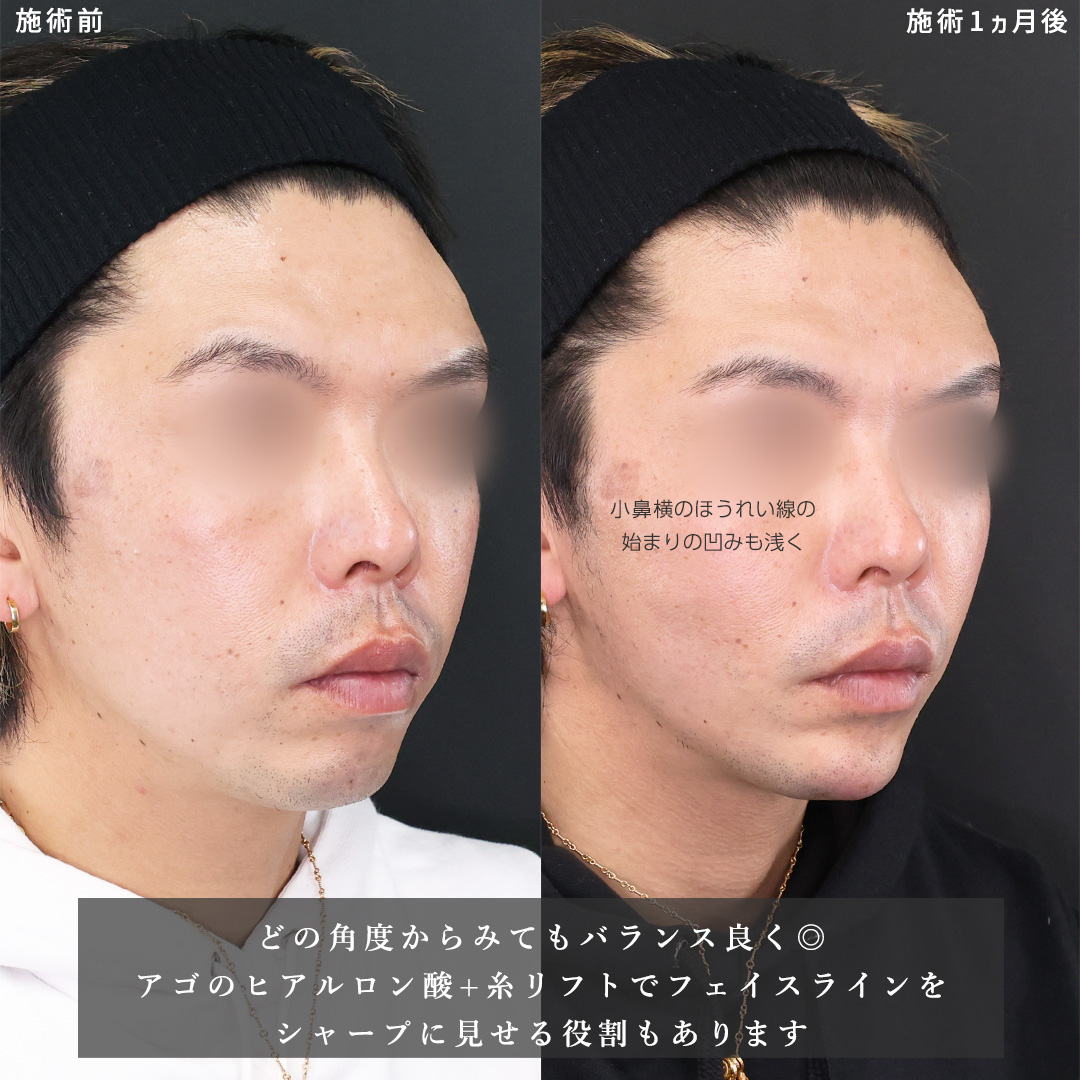 TAC式 ツヤ肌コラーゲンリフト®/TAC式 ショッピングリフト/ほうれい線のヒアルロン酸注射の症例写真 施術前後 