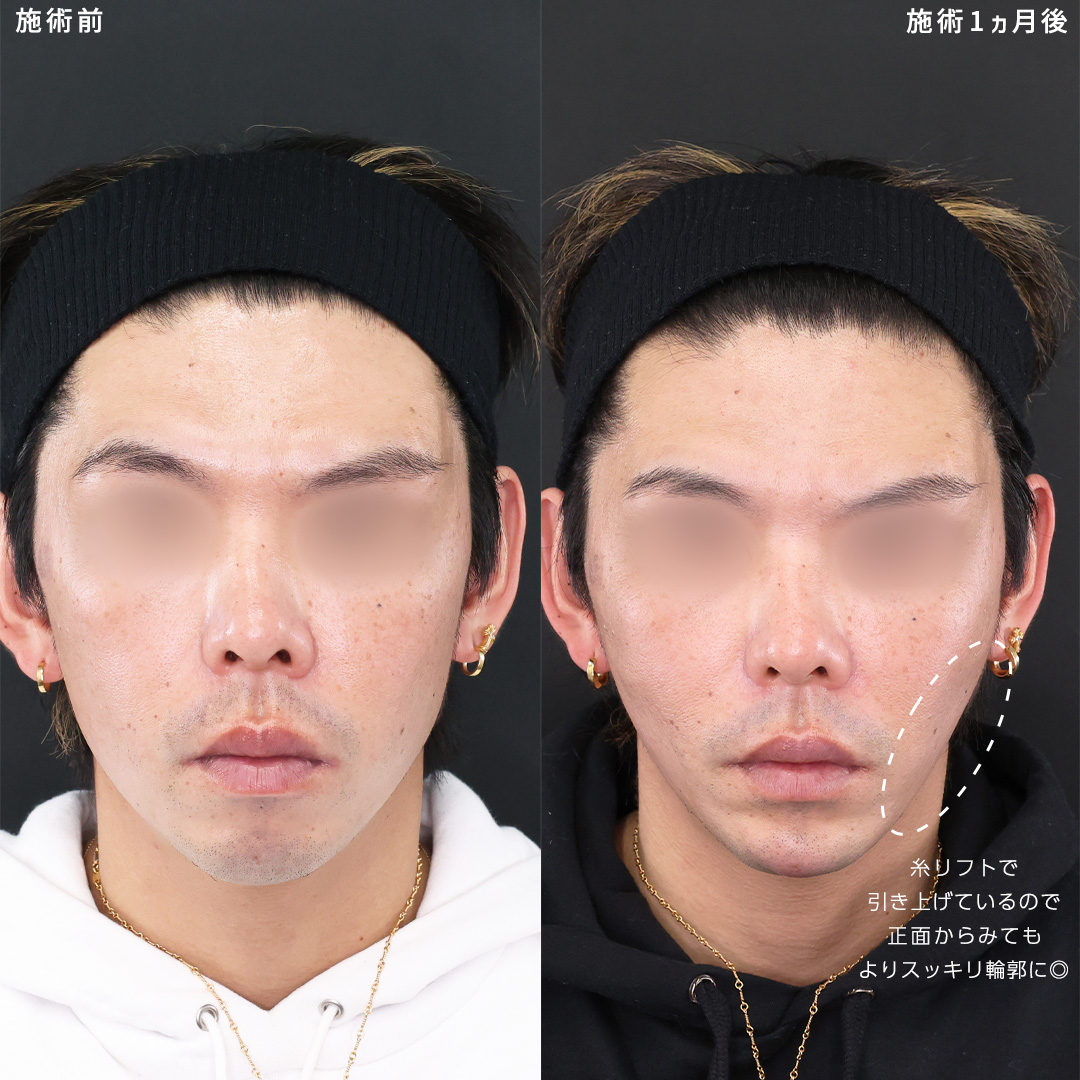 TAC式 ツヤ肌コラーゲンリフト®/TAC式 ショッピングリフト/ほうれい線のヒアルロン酸注射の症例写真 施術前後 