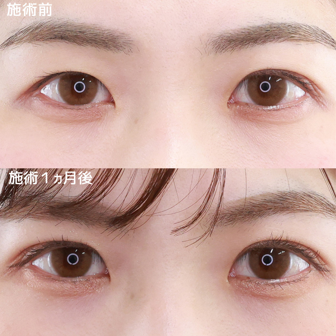 【二重埋没法】自然な末広二重で好印象に！
