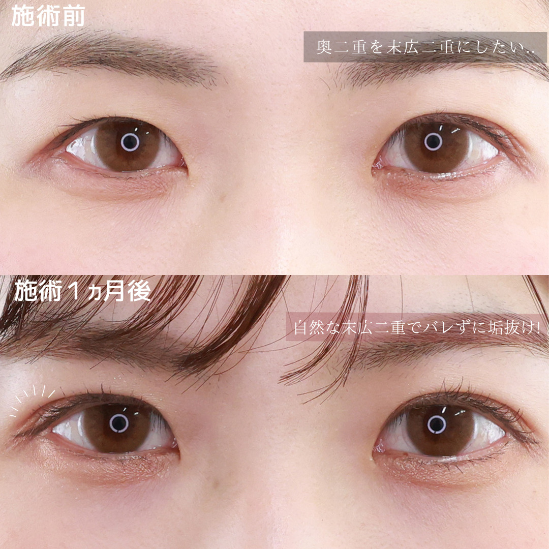 二重埋没法の症例写真 施術前後 