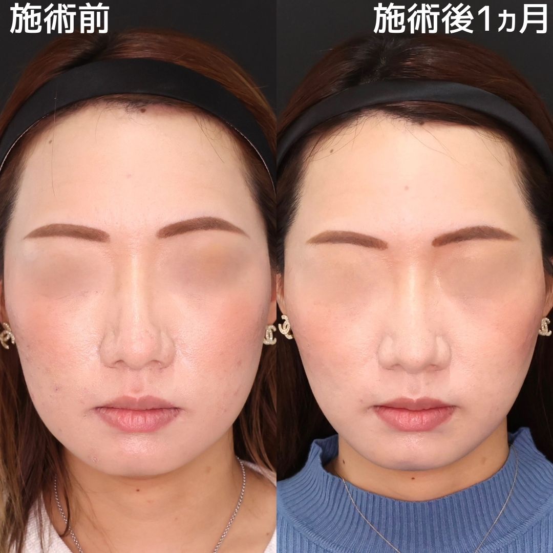 糸リフトでしっかり変化！キュッと引き締まった小顔