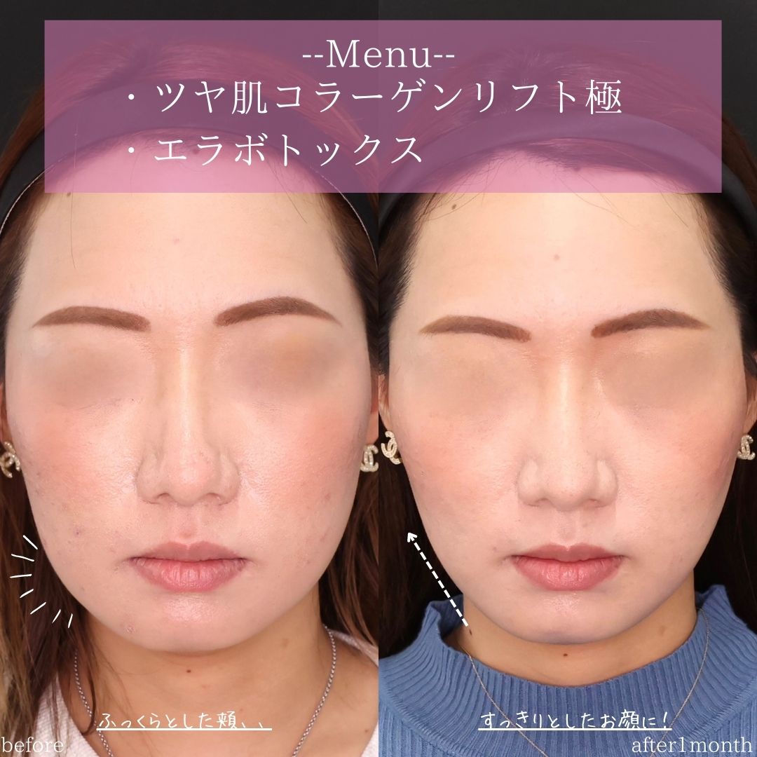 TAC式 ツヤ肌コラーゲンリフト®/エラボトックス注射の症例写真 施術前後 