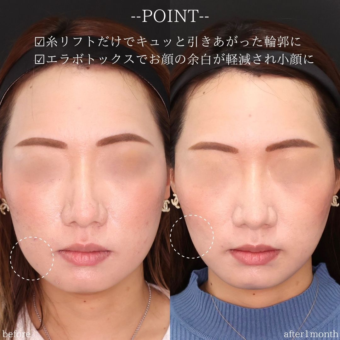 TAC式 ツヤ肌コラーゲンリフト®/エラボトックス注射の症例写真 施術前後 